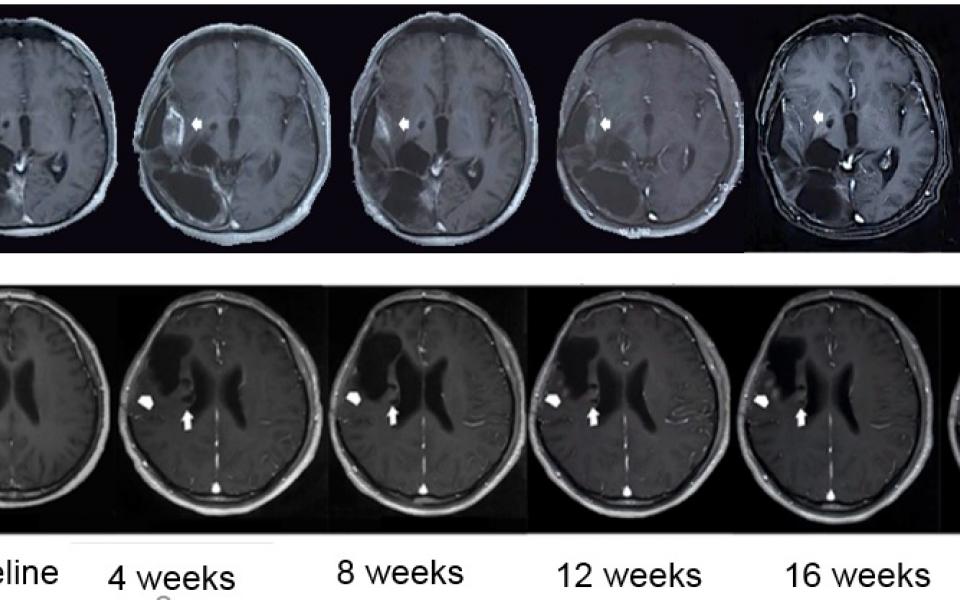 HKUST Researchers Discovered Mutation Route That Helps Find New Therapeutic Lead for Deadly Brain Cancer Patients