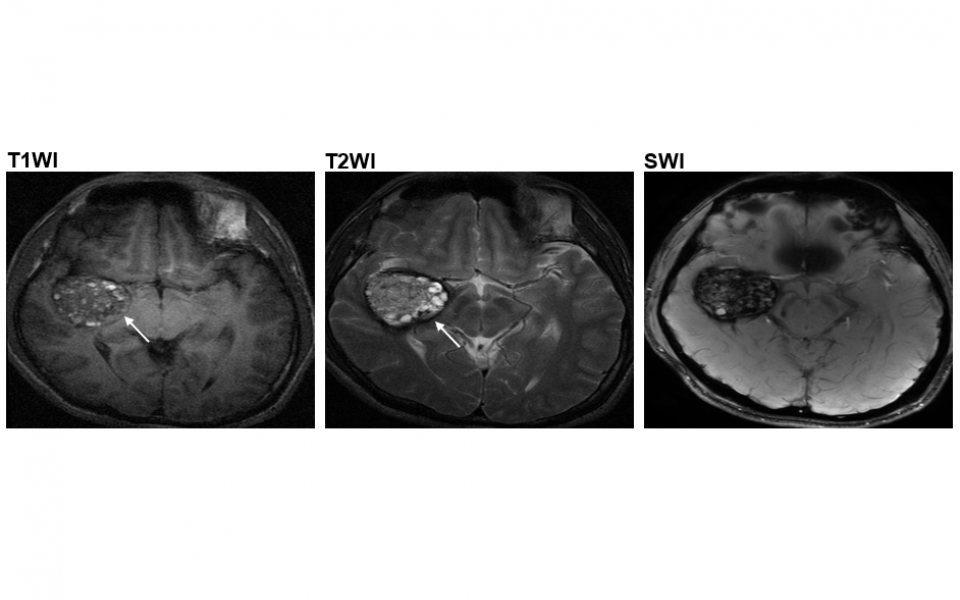 The popcorn-like lesions (as indicated by the arrows) in the brain arteries of type II CCM patients.