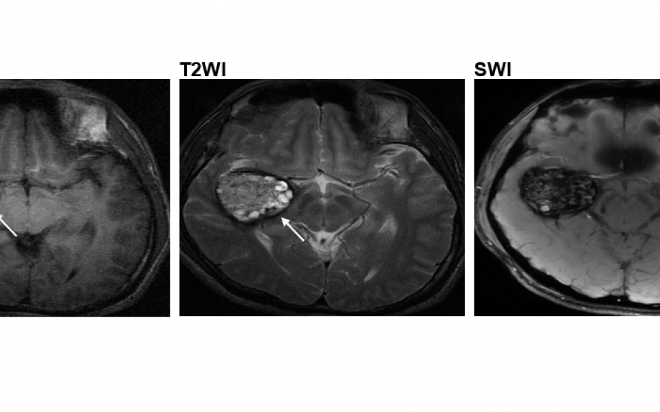 The popcorn-like lesions (as indicated by the arrows) in the brain arteries of Type II CCM patients