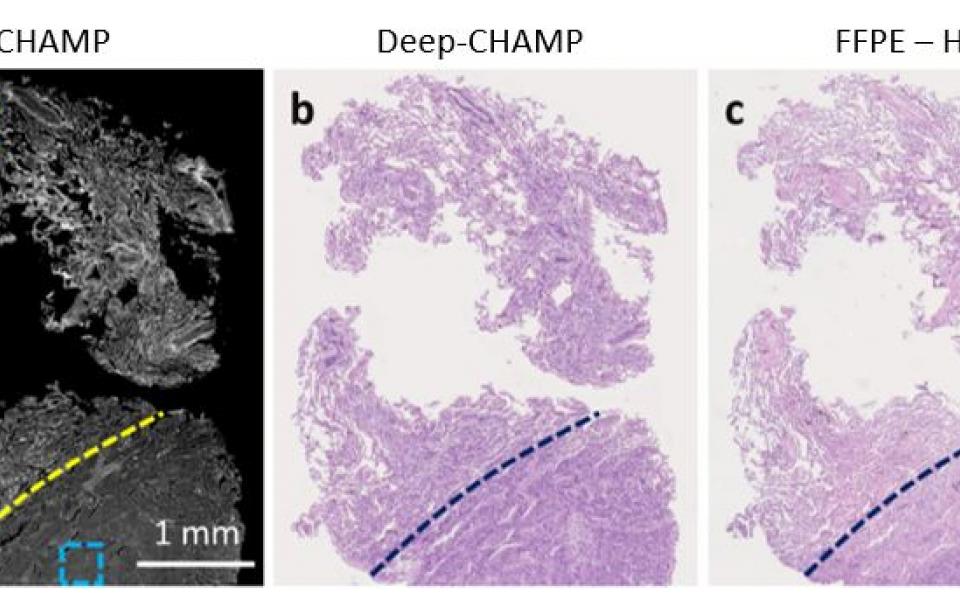 In just three minutes, the CHAMP microscope first generates a greyscale image (left, a) of the patient’s tissue sample and then virtually colors it (middle, b) to indicate the locations of cancer cells for doctors. The result is comparable to that of an image generated by a conventional one-week test (right, c), which is regarded as the gold standard in the medical profession.